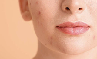 Come riconoscere e trattare l'acne ormonale: Guida completa - AYAY Blog