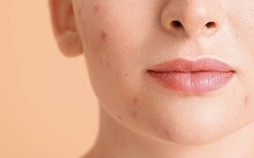 Come riconoscere e trattare l'acne ormonale: Guida completa - AYAY Blog